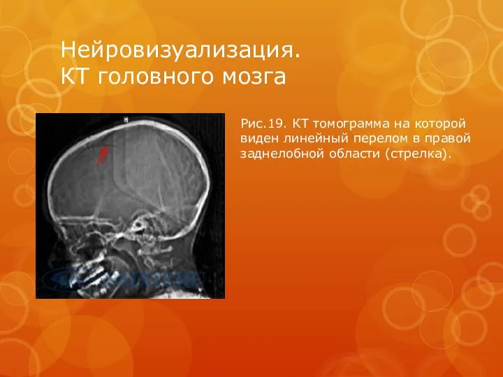 Нейровизуализация. КТ головного мозга Рис.19. КТ томограмма на которой виден линейный