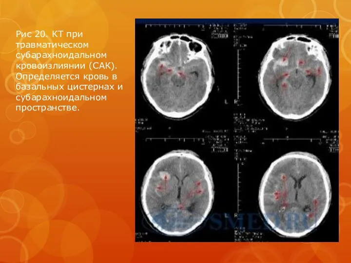 Рис 20. КТ при травматическом субарахноидальном кровоизлиянии (САК). Определяется кровь в базальных цистернах и субарахноидальном пространстве.