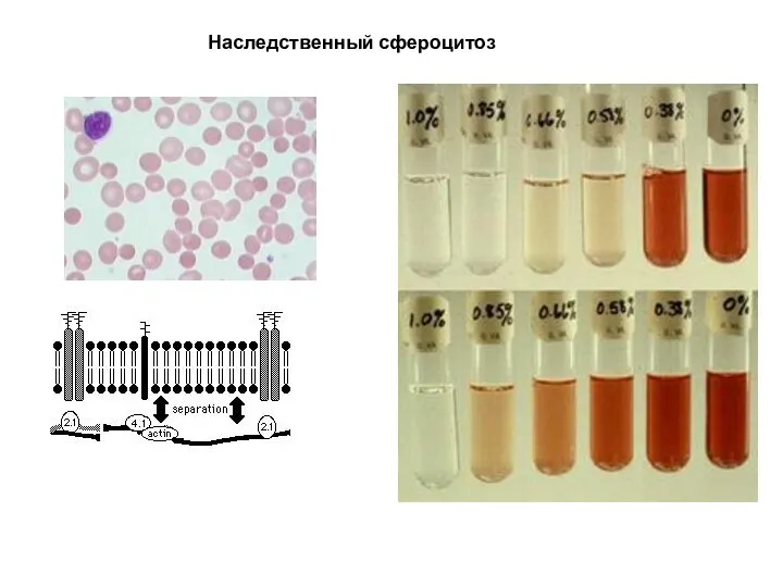 Наследственный сфероцитоз