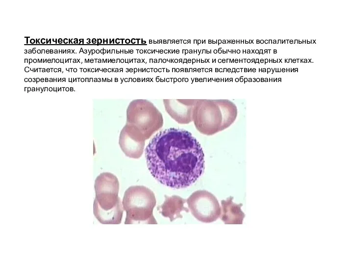 Токсическая зернистость выявляется при выраженных воспалительных заболеваниях. Азурофильные токсические гранулы обычно