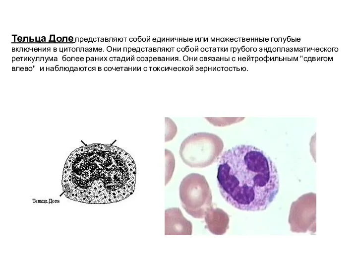 Тельца Доле представляют собой единичные или множественные голубые включения в цитоплазме.