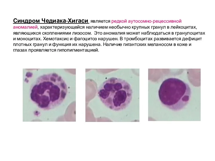 Синдром Чедиака-Хигаси является редкой аутосомно-рецессивной аномалией, характеризующейся наличием необычно крупных гранул