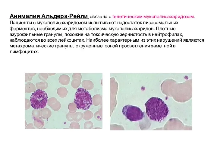 Анималия Альдера-Рейли связана с генетическим мукополисахаридозом. Пациенты с мукополисахаридозом испытывают недостаток