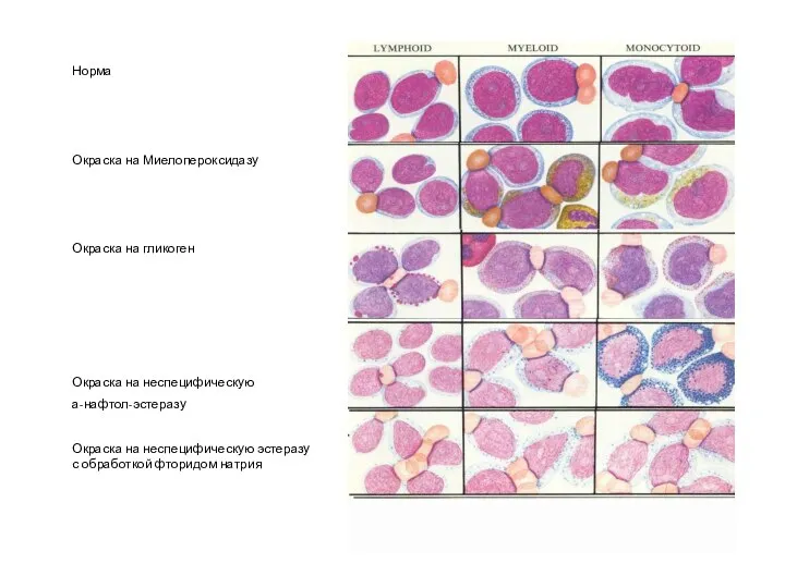 Норма Окраска на Миелопероксидазу Окраска на гликоген Окраска на неспецифическую а-нафтол-эстеразу