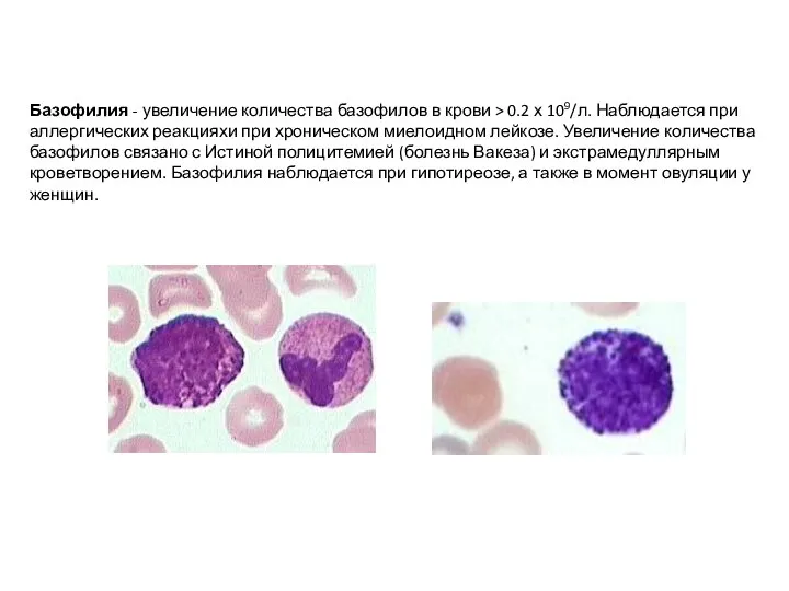 Базофилия - увеличение количества базофилов в крови > 0.2 х 109/л.