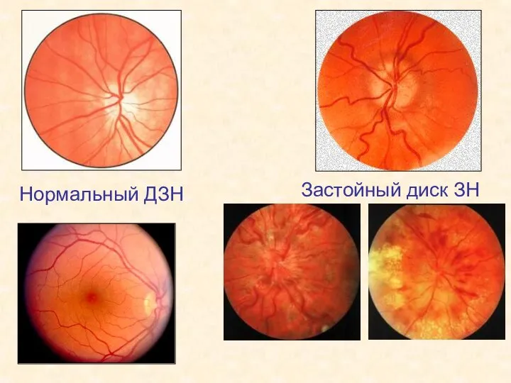 Застойный диск ЗН Нормальный ДЗН