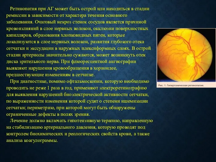 Ретинопатия при АГ может быть острой или находиться в стадии ремиссии