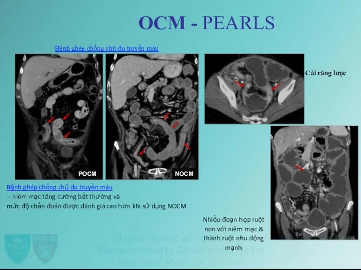 OCM - PEARLS Bệnh ghép chống chủ do truyền máu Cài