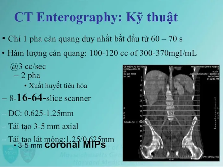 CT Enterography: Kỹ thuật • Chỉ 1 pha cản quang duy