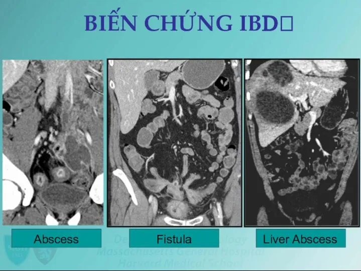 BIẾN CHỨNG IBDꢀ Abscess Fistula Liver Abscess