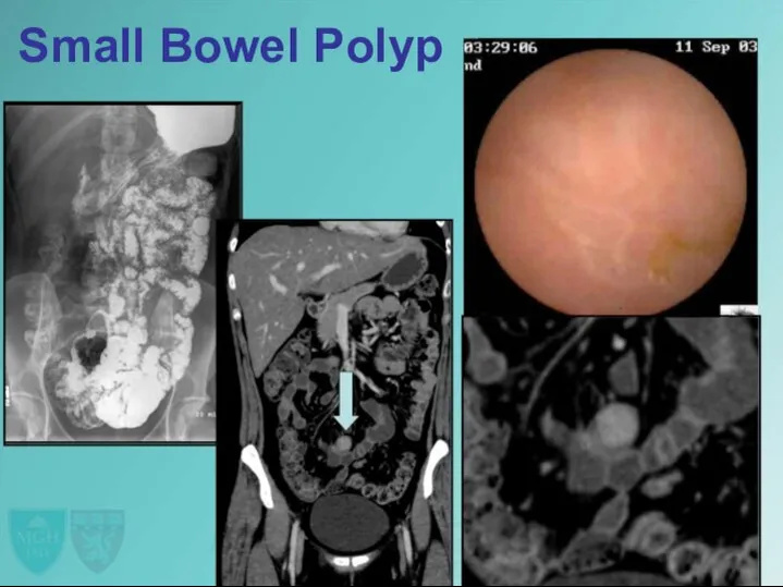 Small Bowel Polyp