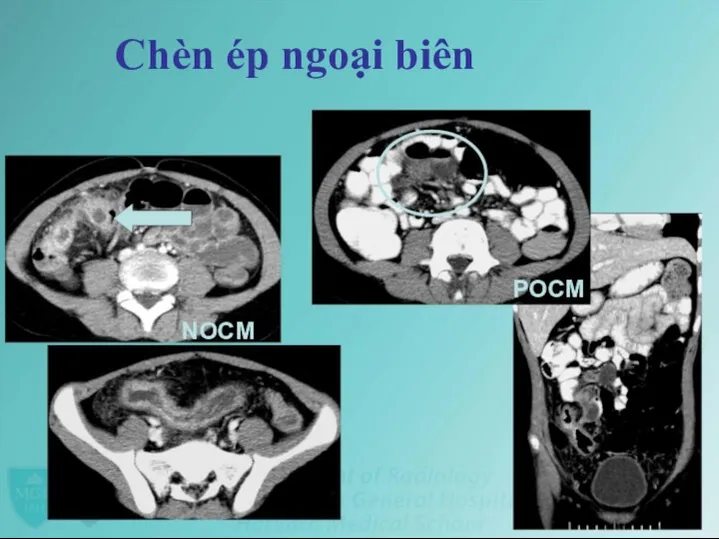 Chèn ép ngoại biên POCM NOCM