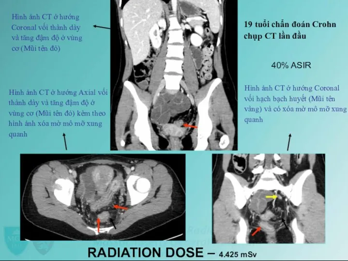 Hình ảnh CT ở hướng Coronal vối thành dày và tăng