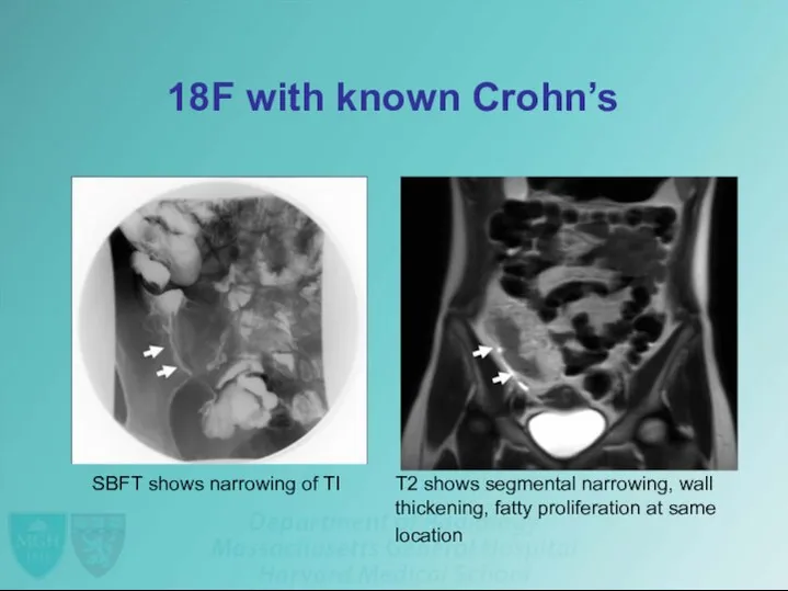 18F with known Crohn’s SBFT shows narrowing of TI T2 shows