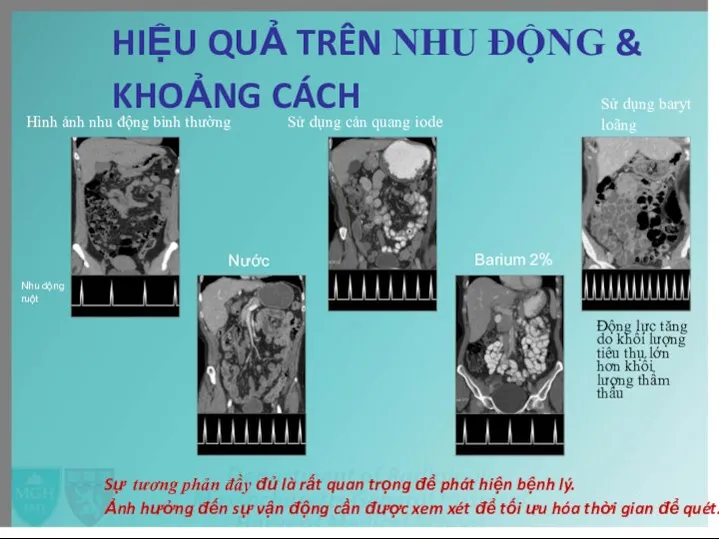 HIỆU QUẢ TRÊN NHU ĐỘNG & KHOẢNG CÁCH Hình ảnh nhu