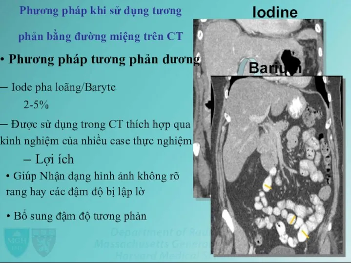 Iodine Phương pháp khi sử dụng tương phản bằng đường miệng