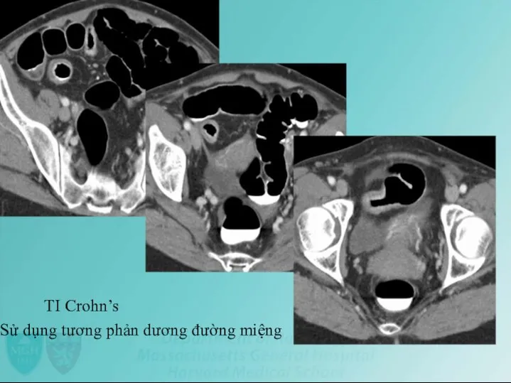 TI Crohn’s Sử dụng tương phản dương đường miệng