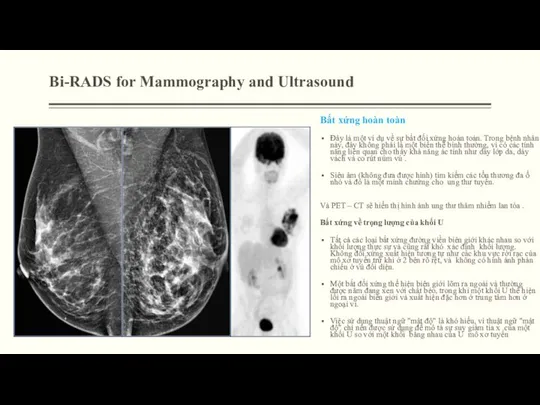 Bi-RADS for Mammography and Ultrasound Bất xứng hoàn toàn Đây là