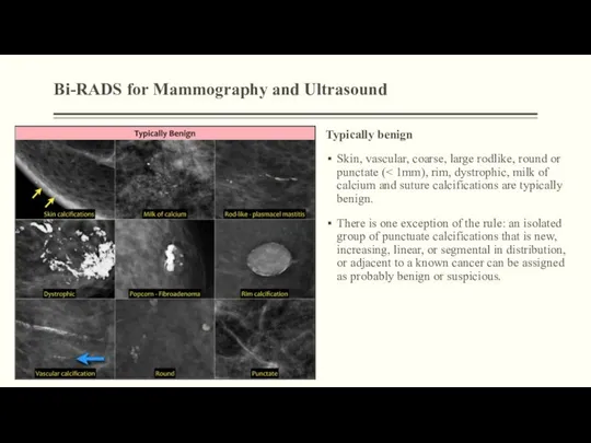 Bi-RADS for Mammography and Ultrasound Typically benign Skin, vascular, coarse, large