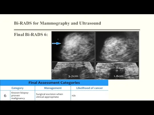 Bi-RADS for Mammography and Ultrasound Final Bi-RADS 6: