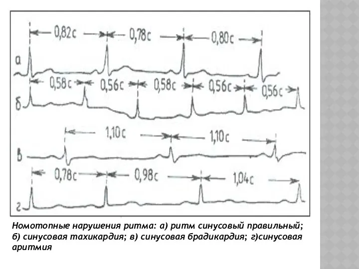 Номотопные нарушения ритма: а) ритм синусовый правильный; б) синусовая тахикардия; в) синусовая брадикардия; г)синусовая аритмия