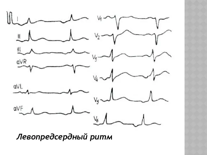 Левопредсердный ритм