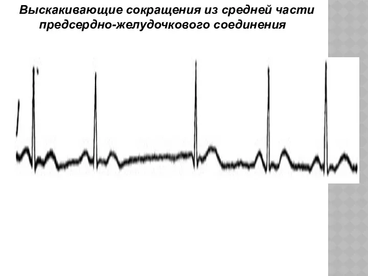 Выскакивающие сокращения из средней части предсердно-желудочкового соединения