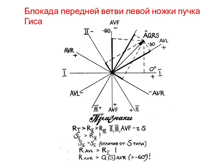 Блокада передней ветви левой ножки пучка Гиса