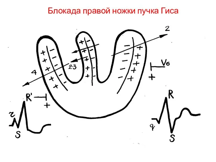 Блокада правой ножки пучка Гиса