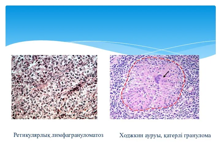 Ретикулярлық лимфагрануломатоз Ходжкин ауруы, қатерлі гранулома