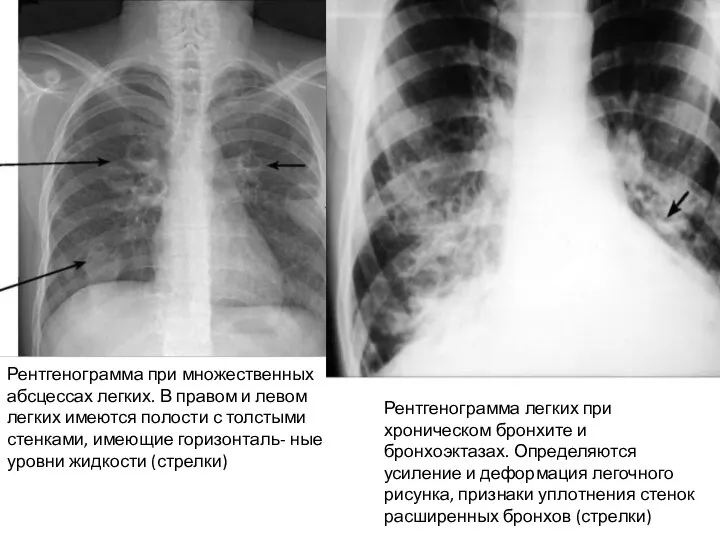 Рентгенограмма при множественных абсцессах легких. В правом и левом легких имеются