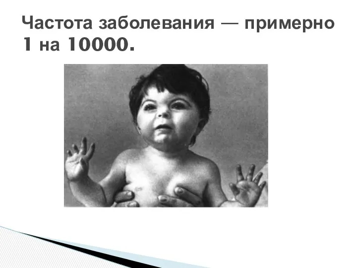 Частота заболевания — примерно 1 на 10000.