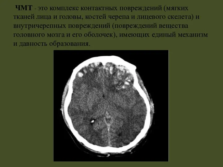 ЧМТ - это комплекс контактных повреждений (мягких тканей лица и головы,