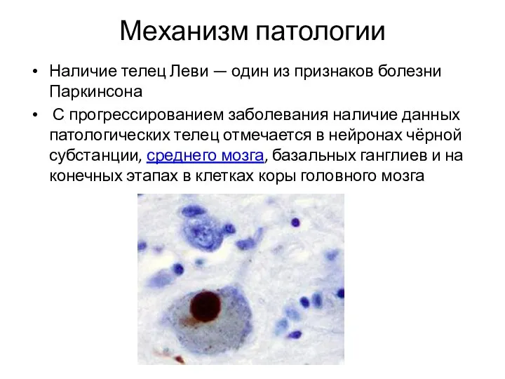 Механизм патологии Наличие телец Леви — один из признаков болезни Паркинсона