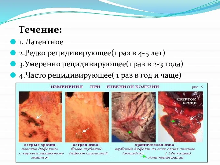 Течение: 1. Латентное 2.Редко рецидивирующее(1 раз в 4-5 лет) 3.Умеренно рецидивирующее(1