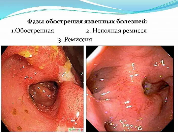 Фазы обострения язвенных болезней: 1.Обостренная 2. Неполная ремисся 3. Ремиссия