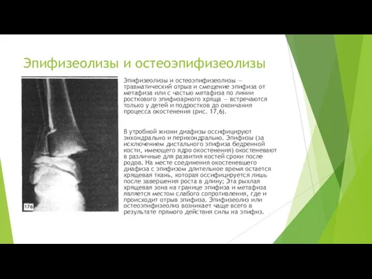 Эпифизеолизы и остеоэпифизеолизы Эпифизеолизы и остеоэпифизеолизы — травматический отрыв и смеще­ние