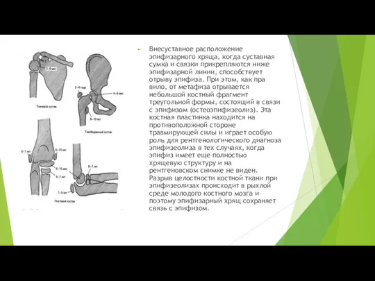 Внесуставное расположение эпифизарного хряща, когда суставная сумка и связки прикрепляются ниже