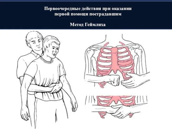 Первоочередные действия при оказании первой помощи пострадавшим Метод Геймлиха