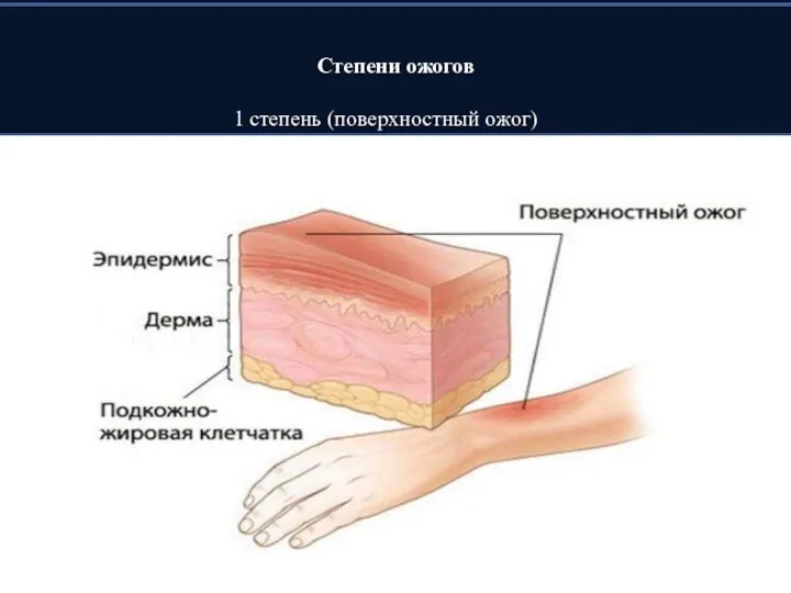 Степени ожогов 1 степень (поверхностный ожог)