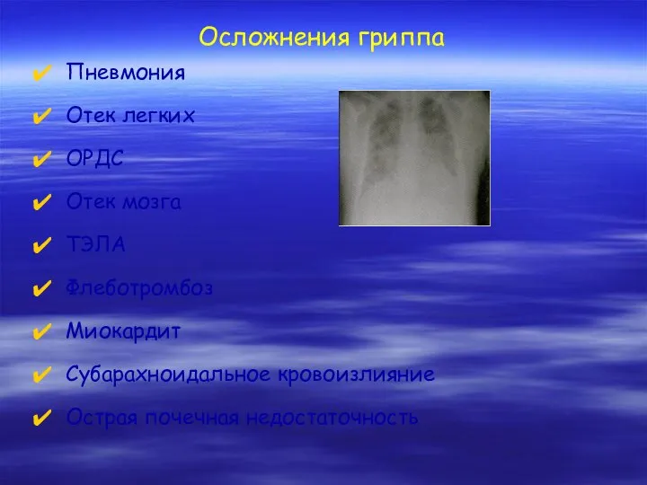 Осложнения гриппа Пневмония Отек легких ОРДС Отек мозга ТЭЛА Флеботромбоз Миокардит Субарахноидальное кровоизлияние Острая почечная недостаточность