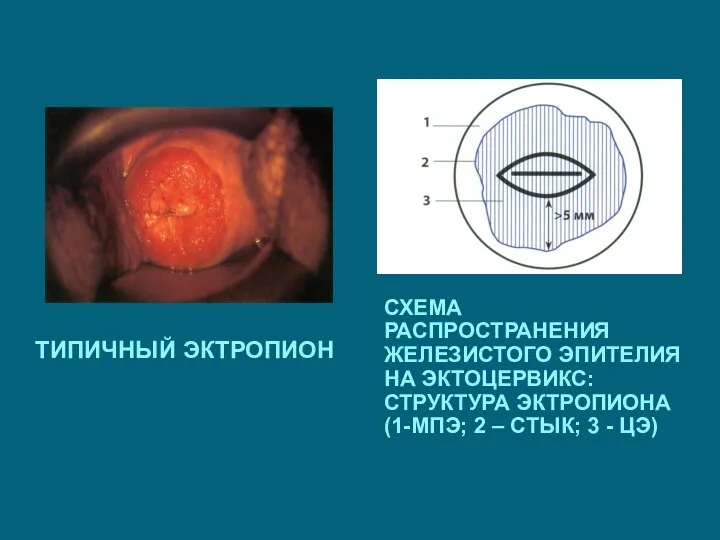 ТИПИЧНЫЙ ЭКТРОПИОН СХЕМА РАСПРОСТРАНЕНИЯ ЖЕЛЕЗИСТОГО ЭПИТЕЛИЯ НА ЭКТОЦЕРВИКС: СТРУКТУРА ЭКТРОПИОНА (1-МПЭ;