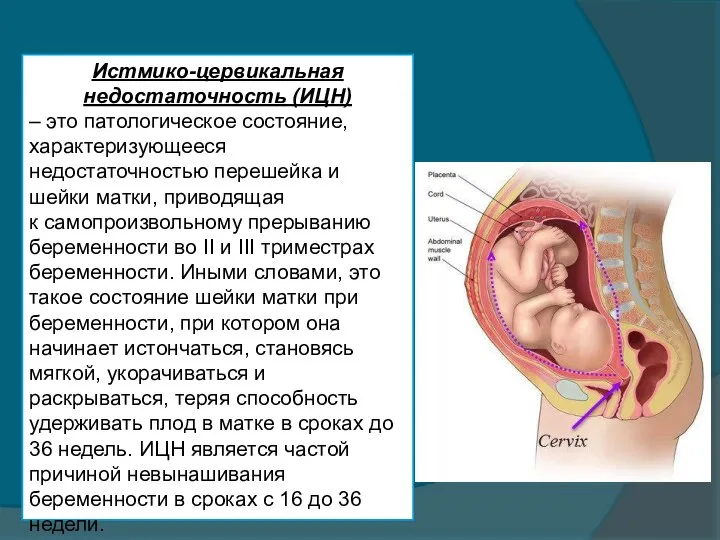 Истмико-цервикальная недостаточность (ИЦН) – это патологическое состояние, характеризующееся недостаточностью перешейка и