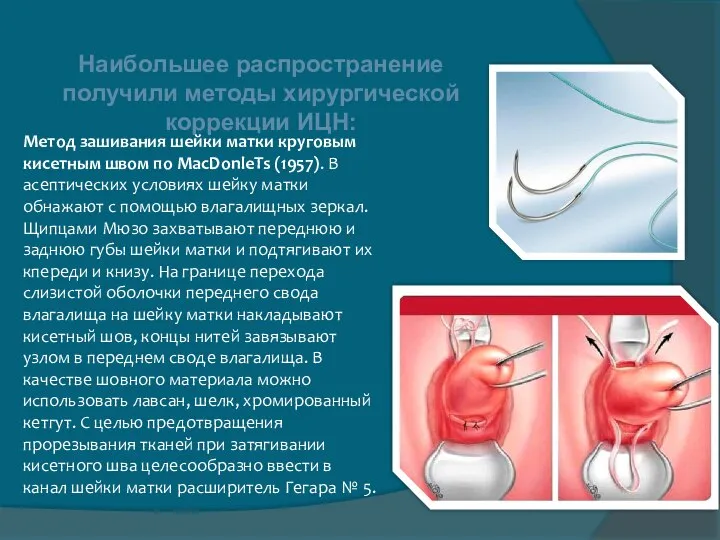 Наибольшее распространение получили методы хирургической коррекции ИЦН: Метод зашивания шейки матки