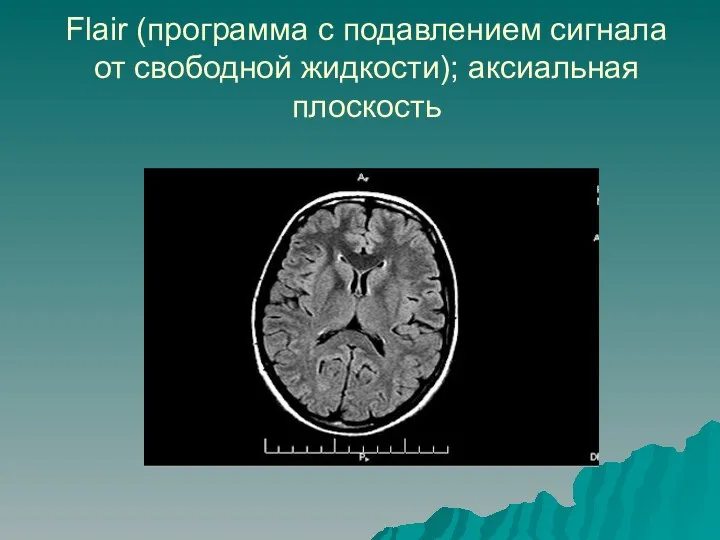 Flair (программа с подавлением сигнала от свободной жидкости); аксиальная плоскость