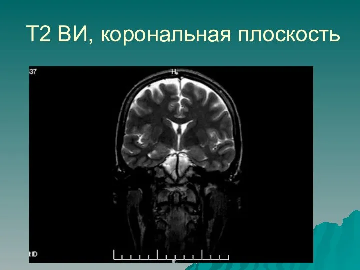 Т2 ВИ, корональная плоскость