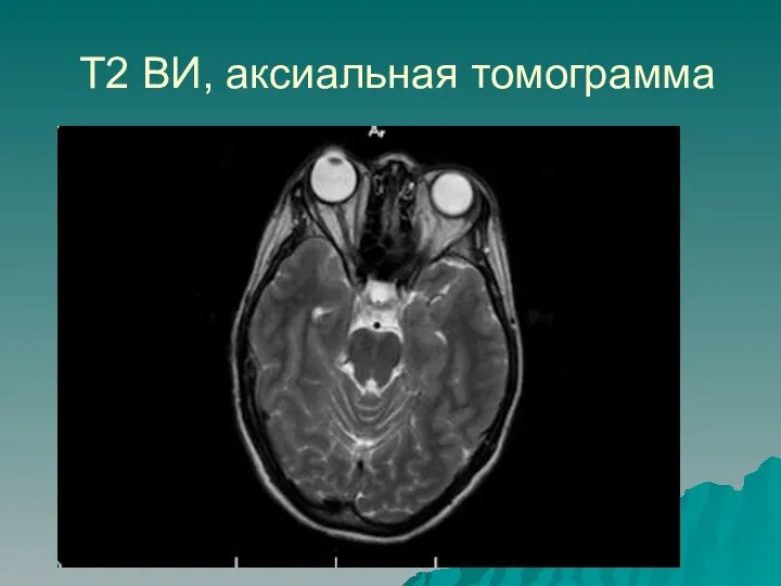 Т2 ВИ, аксиальная томограмма