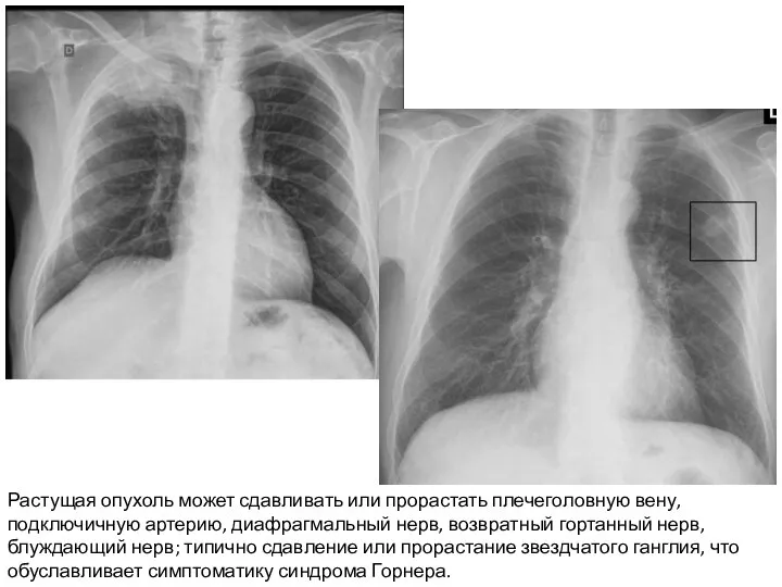 Растущая опухоль может сдавливать или прорастать плечеголовную вену, подключичную артерию, диафрагмальный