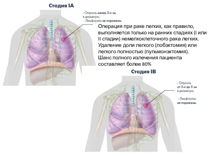 Операция при раке легких, как правило, выполняется только на ранних стадиях