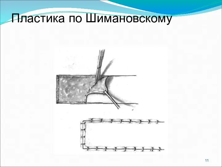 Пластика по Шимановскому